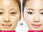 ilustrasi-wajah-v-shape-tanpa-operasi.jpg