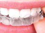 invisalign-4.jpg