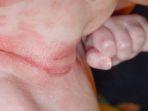 iritasi-kulit-bayi-9.jpg