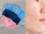 jerawat-akibat-penggunaan-masker.jpg