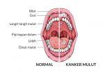 kanker-mulut.jpg