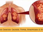 kanker-paru-2.jpg