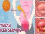 kanker-serviks-6.jpg