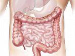 kanker-usus-2.jpg