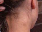 kelenjar-getah-bening-5.jpg