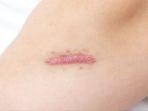 keloid2.jpg