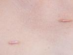 keloid4.jpg