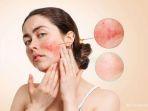 kulit-sensitif-6.jpg