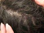 kutu-rambut-2.jpg