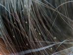 kutu-rambut-8.jpg