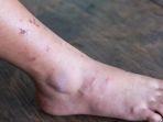 luka-diabetes-1.jpg