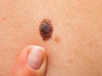melanoma-4.jpg