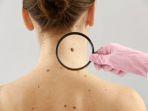 melanoma.jpg