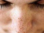 melasma.jpg