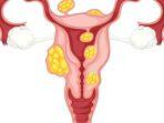 mioma-uteri.jpg
