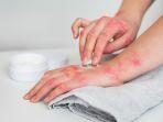 monkeypox-atau-cacar-monyet-ilmuwan-mewaspadai-adanya-kasus-tanpa-gejala.jpg
