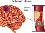 otak-penderita-stroke.jpg