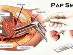 pap-smear-11.jpg