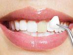 pemasangan-veneer-gigi-2.jpg