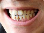 penyakit-periodontitis.jpg