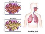 penyakit-pneumonia-2.jpg