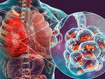 penyakit-pneumonia-3.jpg