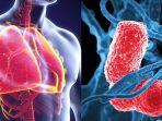 penyakit-pneumonia-7.jpg