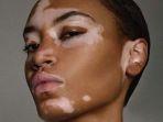 penyakit-vitiligo-2.jpg