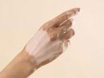 penyakit-vitiligo-4.jpg
