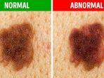 perbedaan-melanoma-dan-tahi-lalat.jpg