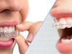 perbedaan-penggunaan-behel-dan-clean-aligner-1.jpg