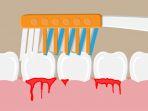 periodontitis-1.jpg