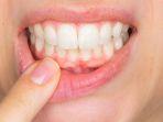 periodontitis-2.jpg