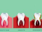 periodontitis-4.jpg