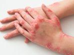 psoriasis-53723.jpg