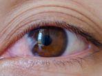 pterygium.jpg