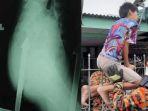 remaja-12-tahun-asal-malaysia-tertusuk-besi-di-pantat.jpg