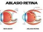 retina-mata-lepas.jpg