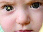 retinoblastoma-5.jpg