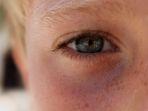 retinoblastoma-6.jpg