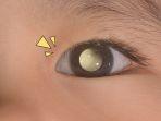 retinoblastoma-7.jpg