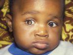 retinoblastoma-8.jpg