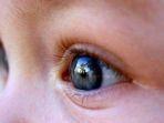 retinoblastoma.jpg