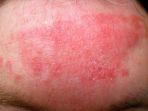 rosacea-1.jpg