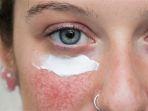 rosacea-2.jpg