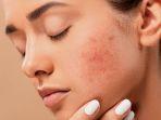 rosacea1.jpg