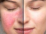 rosacea3.jpg