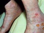 scabies-2.jpg
