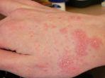 scabies-3.jpg