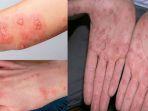 scabies-4.jpg